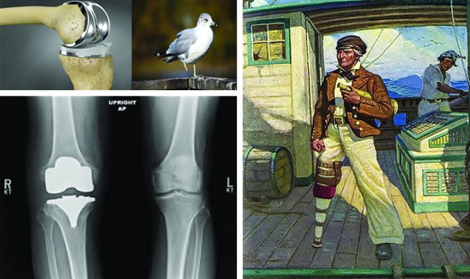 A complete knee replacement is what I need to become seaworthy. Leg issues didn't seem to slow down Ahab in pursuit of his obsession.